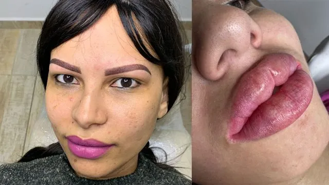 Micropigmentação paramédica: reconstruindo mais do que a pele, restaurando autoestima